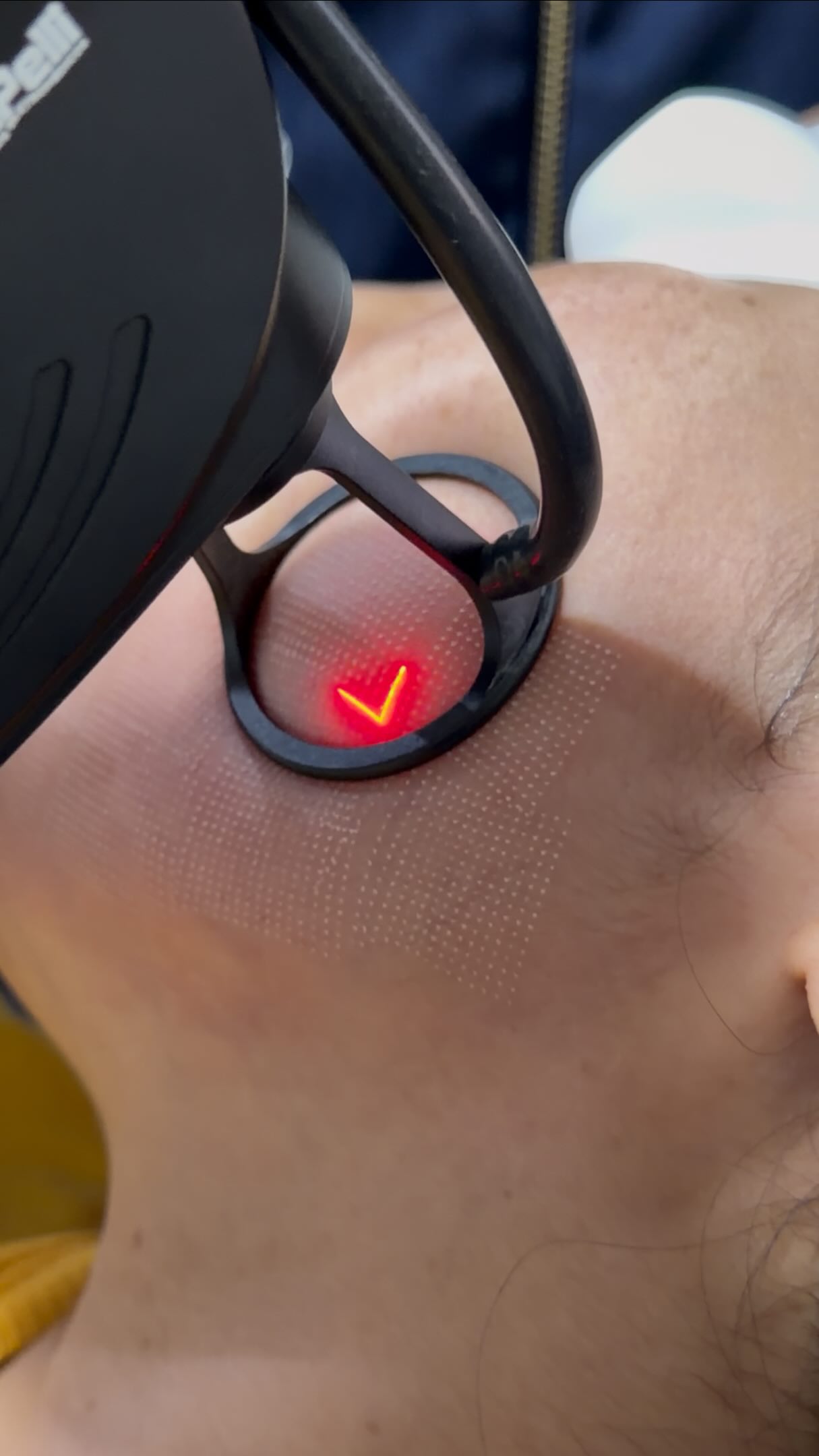 Aplicação de tecnologia a laser com proteção ocular